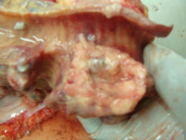 bronchial carcinoma